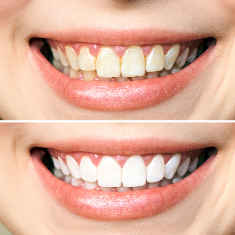 Stomatologica Services - Sbiancamento dentale - Risultati