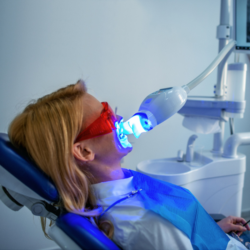 Stomatologica Services - Sbiancamento dentale - Tecnica diretta
