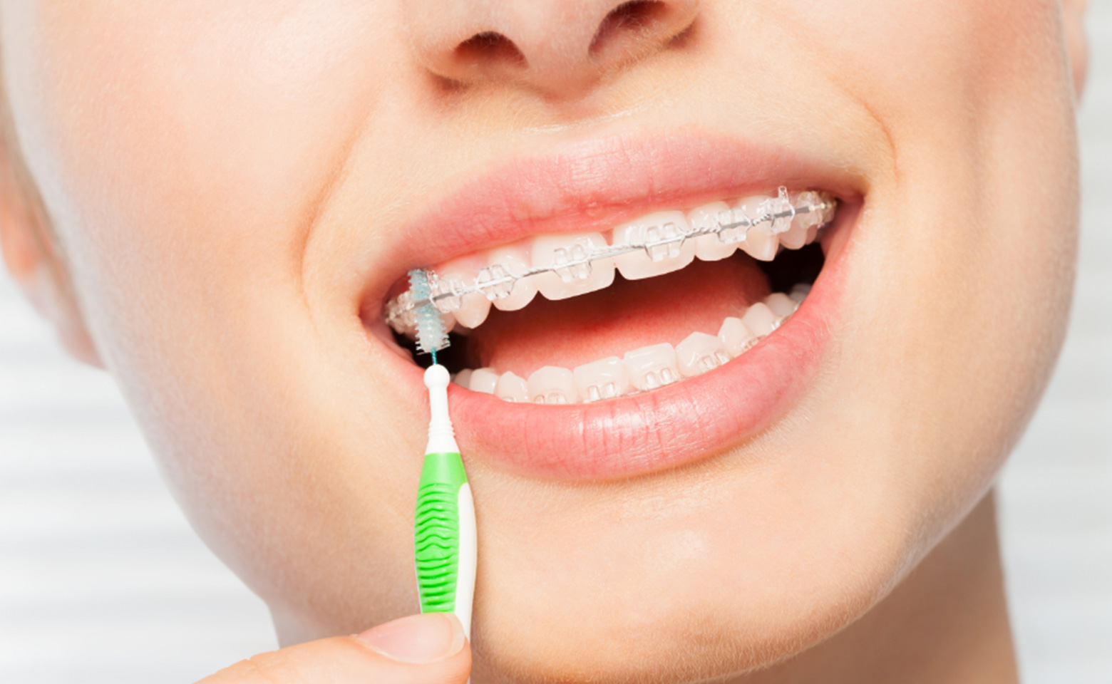Ortodonzia | Stomatologica Services